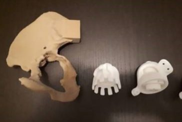 Protesi all'anca in 3d impiantata a Ferrara