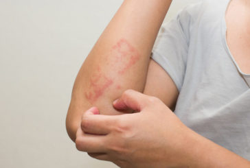 Psoriasi, un nuovo farmaco ottiene la rimborsabilita' dall'Aifa