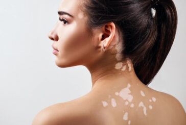 Vitiligine, la cura è più vicina