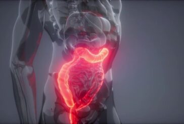 Stenosi diverticolare, diagnosi e intervento di Papa Francesco