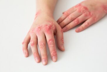 Salutequità e Apiafco "La psoriasi entri nel Piano Nazionale Cronicità"