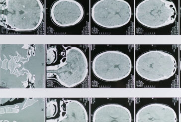 Glioblastoma, le molecole naturali migliorano la chemioterapia