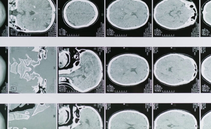 Glioblastoma, le molecole naturali migliorano la chemioterapia