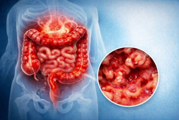 Colite ulcerosa, nuove opzioni terapeutiche