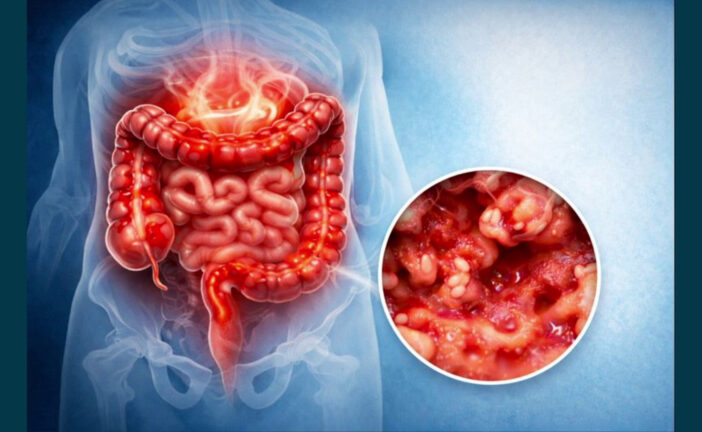 Colite ulcerosa, nuove opzioni terapeutiche